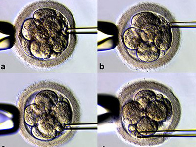 做试管婴儿每个人都需要囊胚培养吗